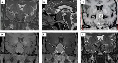 Ectopic acromegaly with tumoral range hyperprolactinemia and apoplexy with a dramatic regression of pituitary hyperplasia